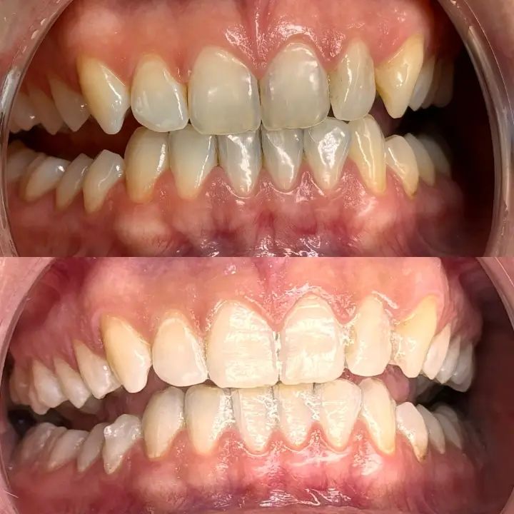 Wybielanie zębów Koszalin (1)