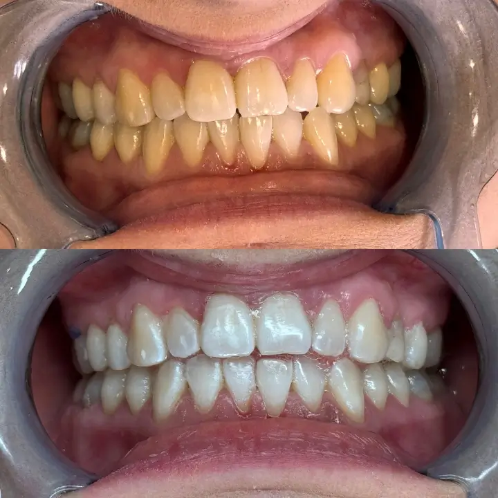 Wybielanie zębów Koszalin (2)