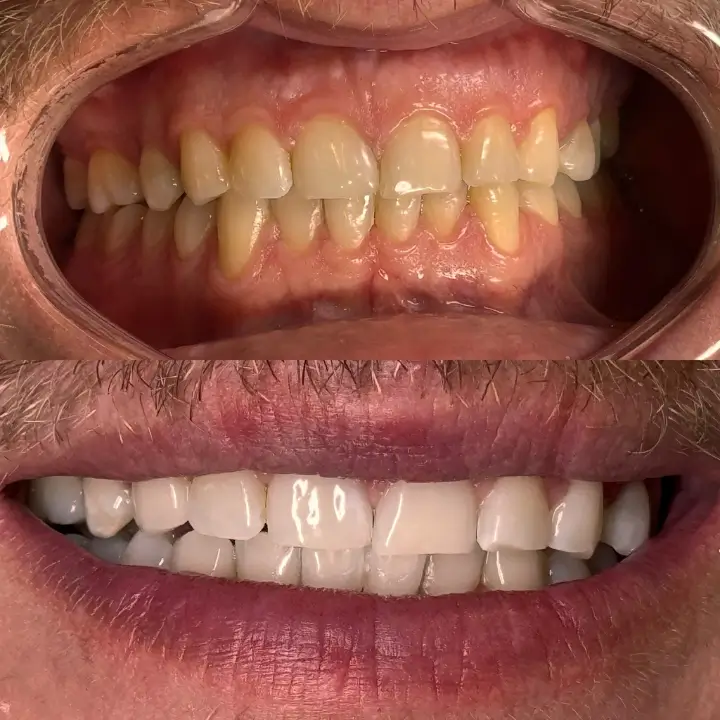 Wybielanie zębów Koszalin (3)